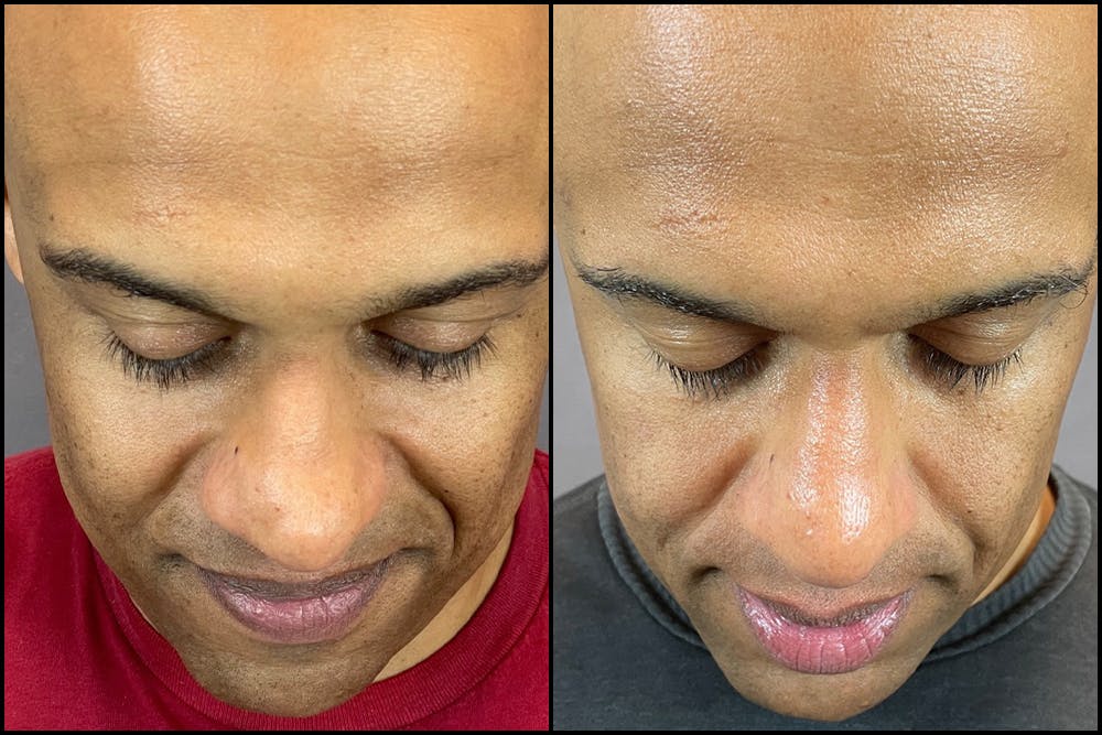 Rhinoplasty Before & After Gallery - Patient 141788647 - Image 8