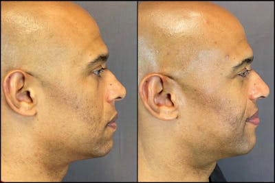 Rhinoplasty Before & After Gallery - Patient 141788647 - Image 1