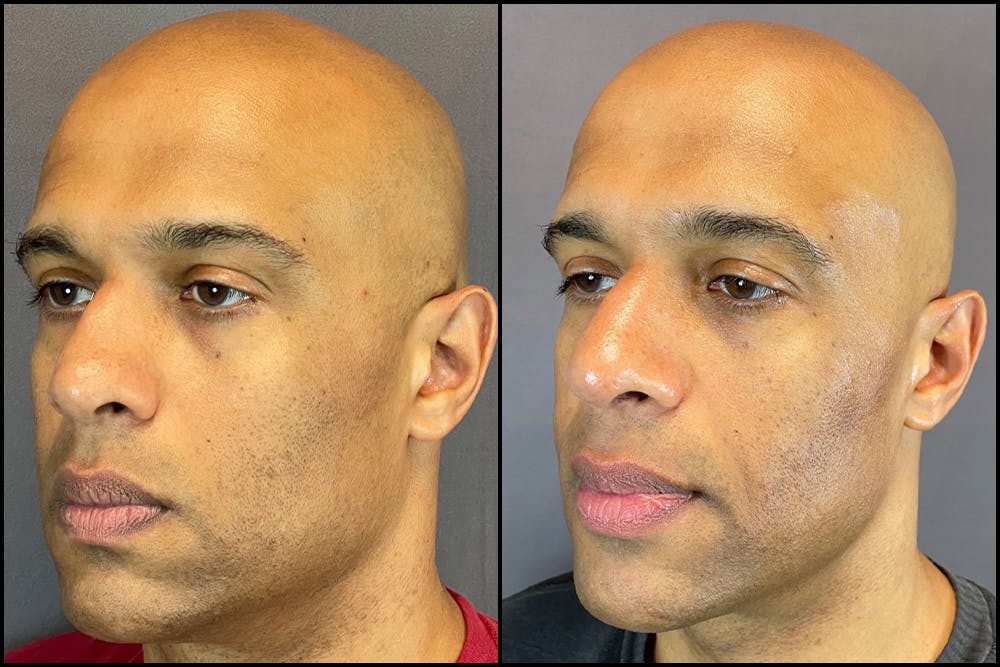 Rhinoplasty Before & After Gallery - Patient 141788647 - Image 4