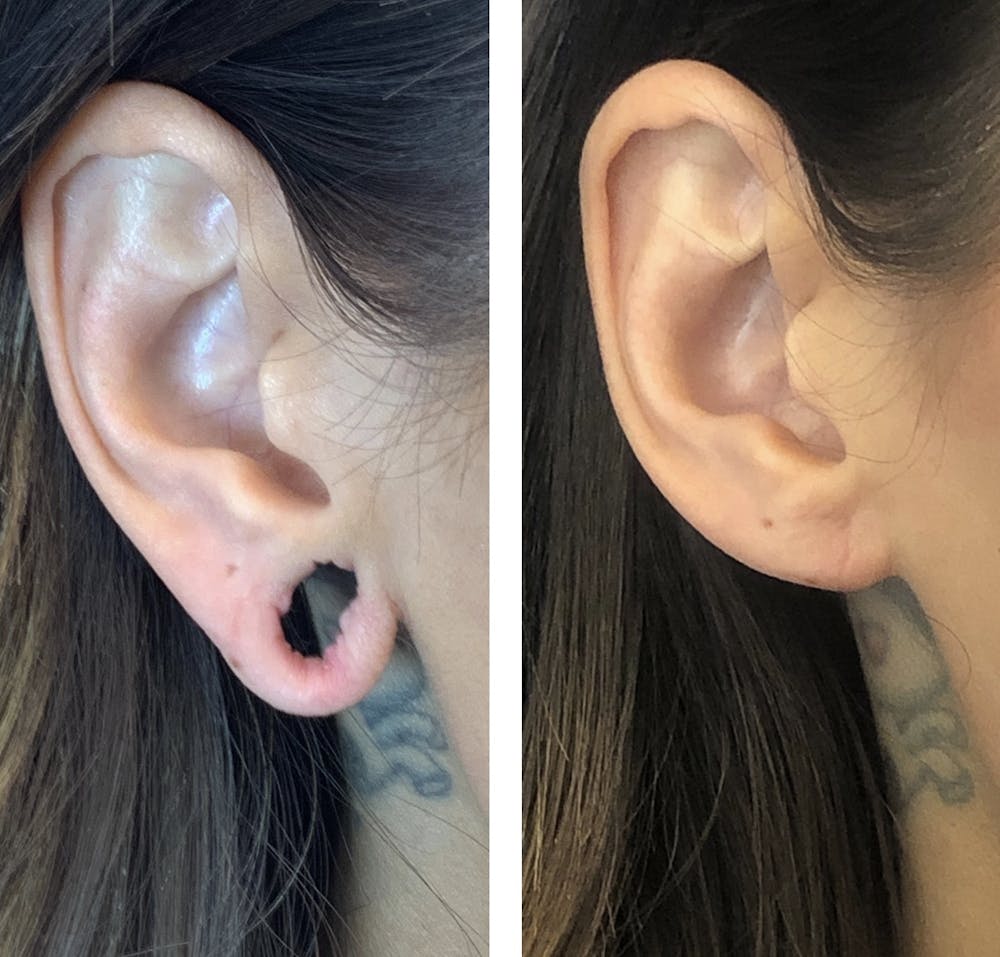 Ear Surgery Before & After Gallery - Patient 121541535 - Image 2