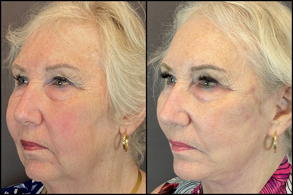 Facelift Before & After Gallery - Patient 141788681 - Image 2