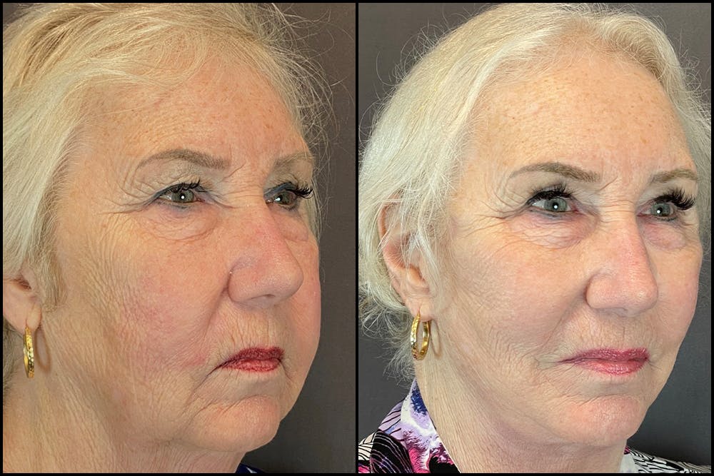 Facelift Before & After Gallery - Patient 141788681 - Image 4