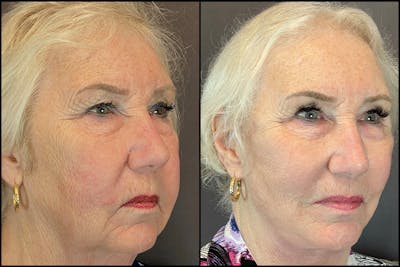 Facelift Before & After Gallery - Patient 141788681 - Image 4
