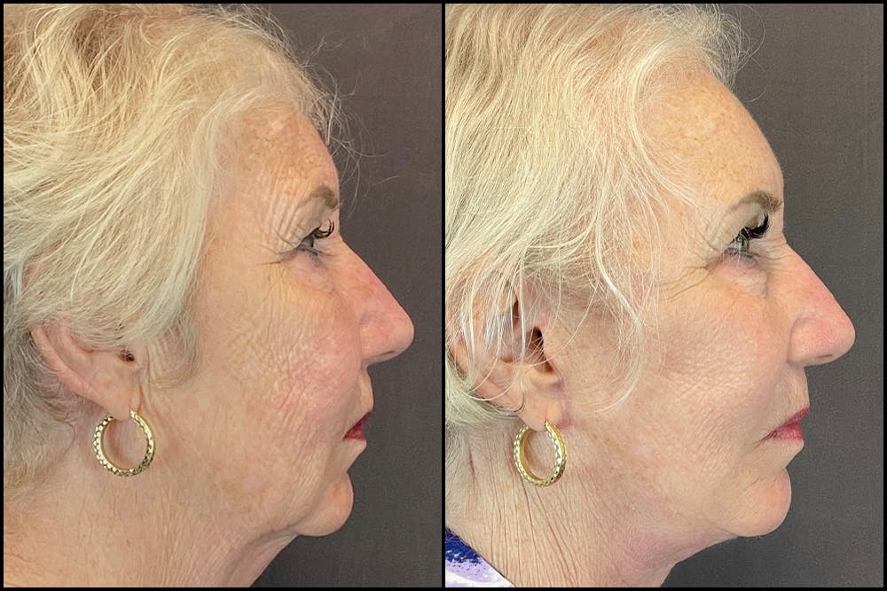 Facelift Before & After Gallery - Patient 141788681 - Image 5