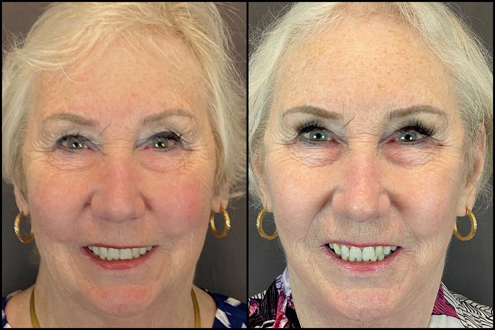Facelift Before & After Gallery - Patient 141788681 - Image 1