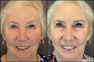 Facelift Before & After Gallery - Patient 141788681 - Image 1