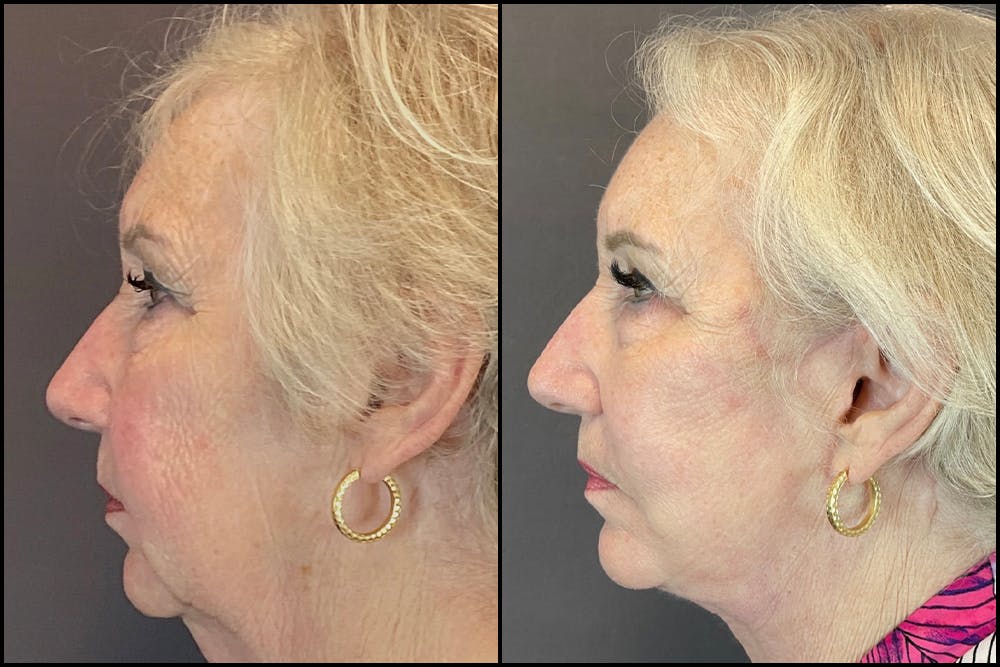Facelift Before & After Gallery - Patient 141788681 - Image 3