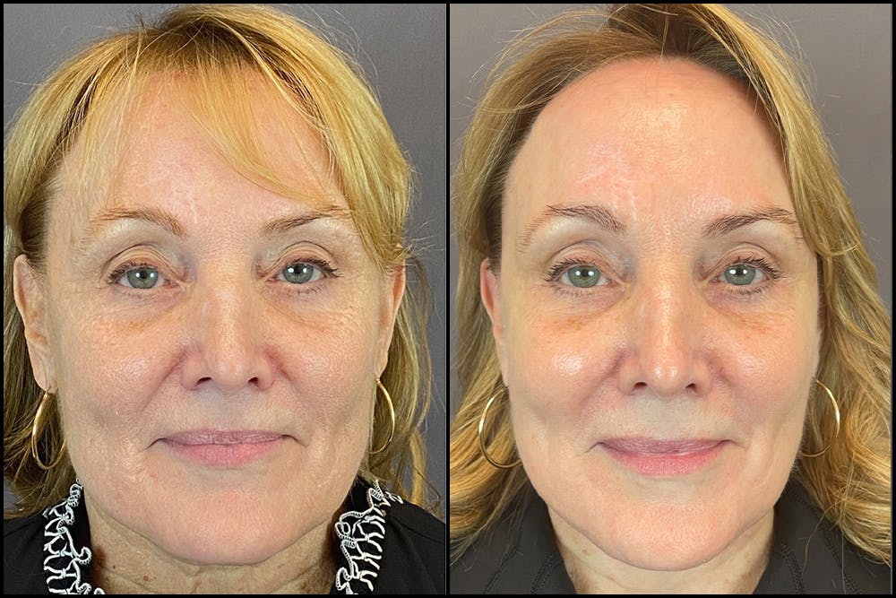 Facelift Before & After Gallery - Patient 141788696 - Image 1