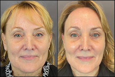 Facelift Before & After Gallery - Patient 141788696 - Image 1