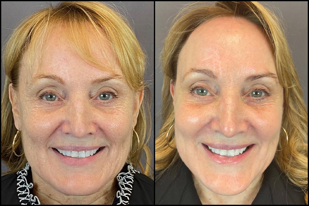 Facelift Before & After Gallery - Patient 141788696 - Image 2