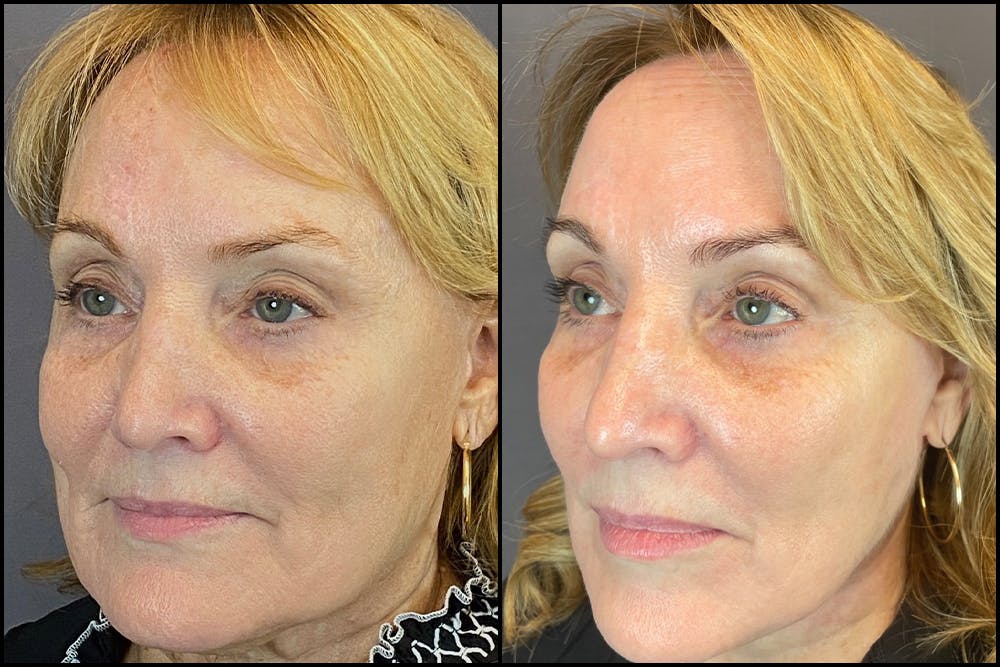 Facelift Before & After Gallery - Patient 141788696 - Image 3