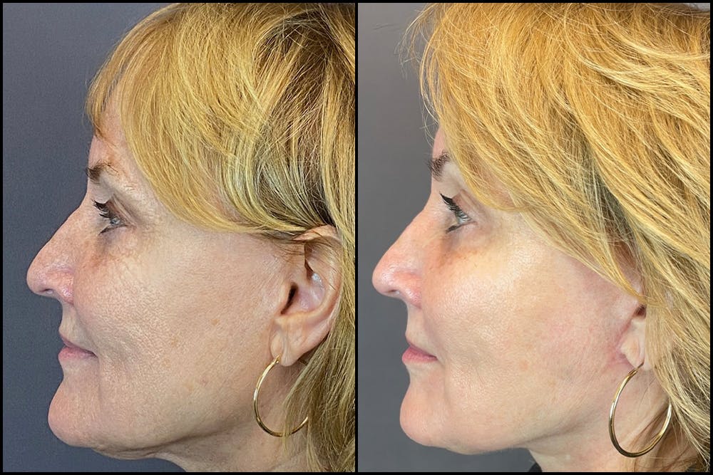 Facelift Before & After Gallery - Patient 141788696 - Image 4