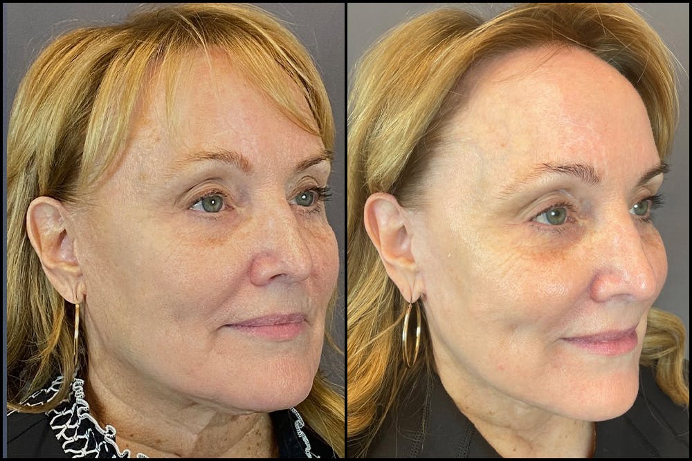 Facelift Before & After Gallery - Patient 141788696 - Image 5