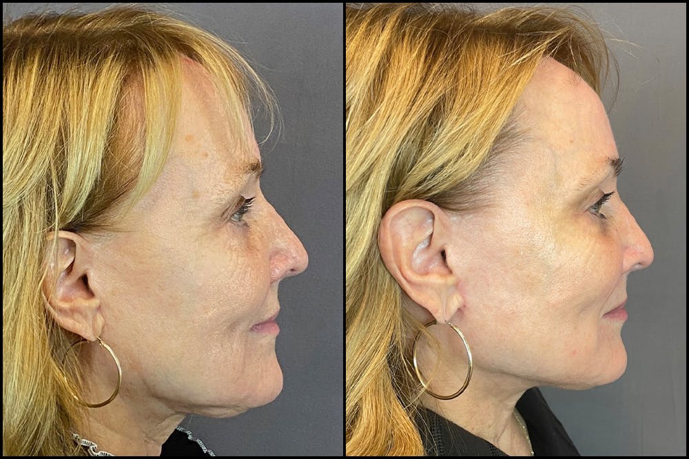 Facelift Before & After Gallery - Patient 141788696 - Image 6