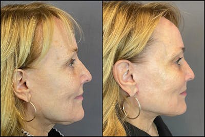 Facelift Before & After Gallery - Patient 141788696 - Image 6