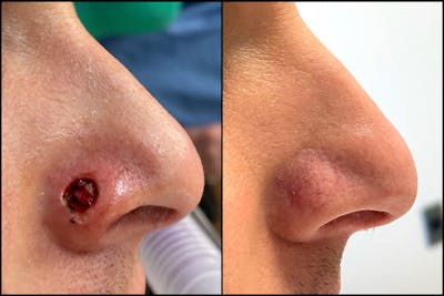 Mohs Reconstruction  Before & After Gallery - Patient 141788698 - Image 1
