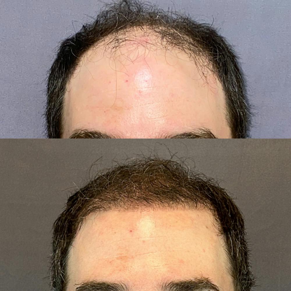 Hair Restoration  Before & After Gallery - Patient 142680393 - Image 1