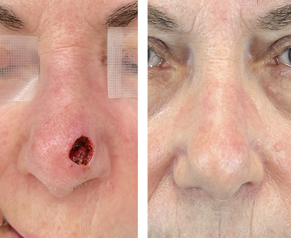 Mohs Reconstruction  Before & After Gallery - Patient 142681504 - Image 1