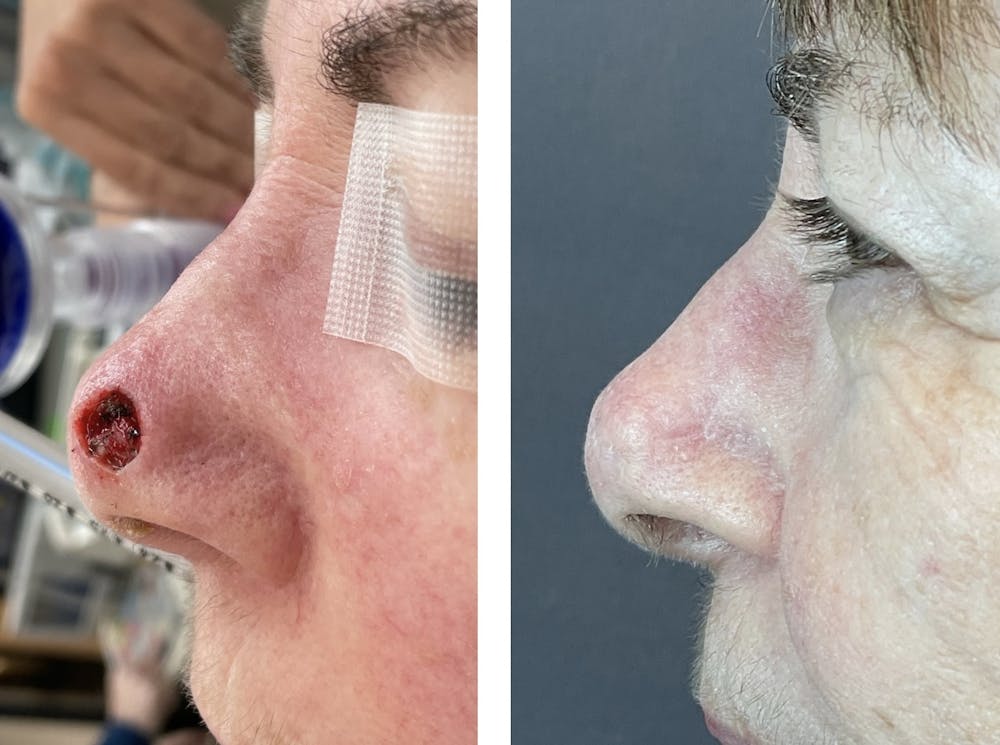 Mohs Reconstruction  Before & After Gallery - Patient 142681504 - Image 2