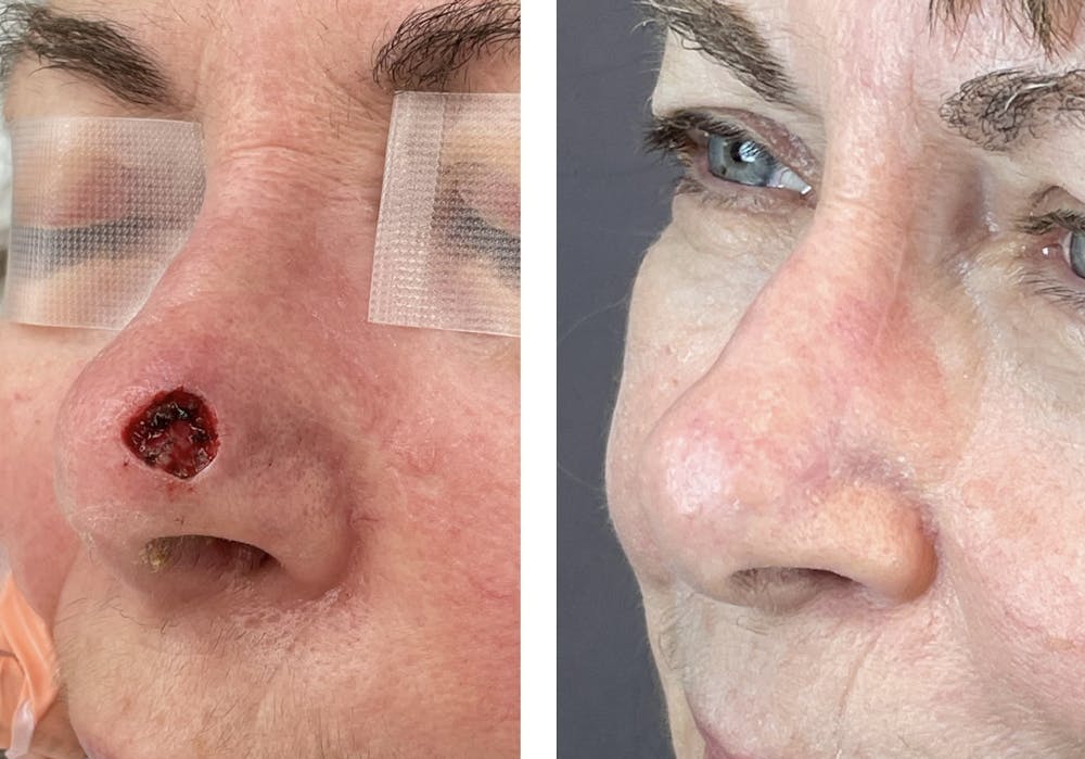 Mohs Reconstruction  Before & After Gallery - Patient 142681504 - Image 3