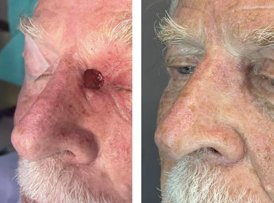 Mohs Reconstruction  Before & After Gallery - Patient 142681505 - Image 1