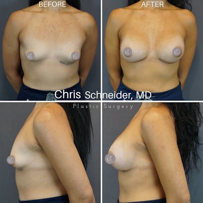 Breast Augmentation Before & After Gallery - Patient 143531739 - Image 1
