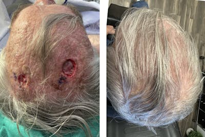 Mohs Reconstruction  Before & After Gallery - Patient 143591520 - Image 1