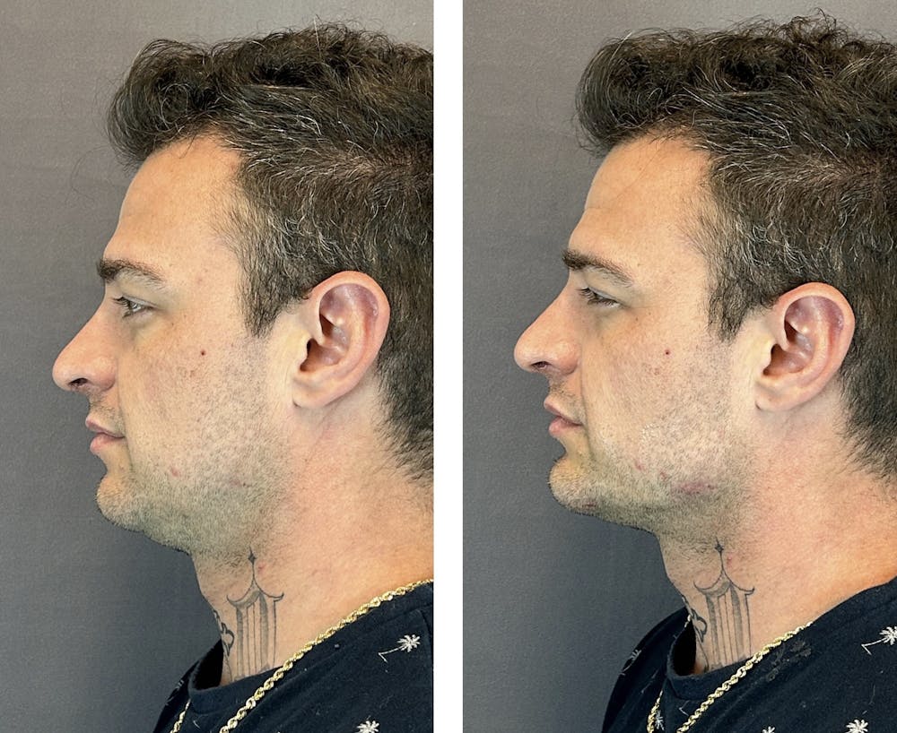 Dermal Fillers Before & After Gallery - Patient 143591521 - Image 4