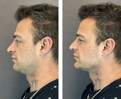 Dermal Fillers Before & After Gallery - Patient 143591521 - Image 4
