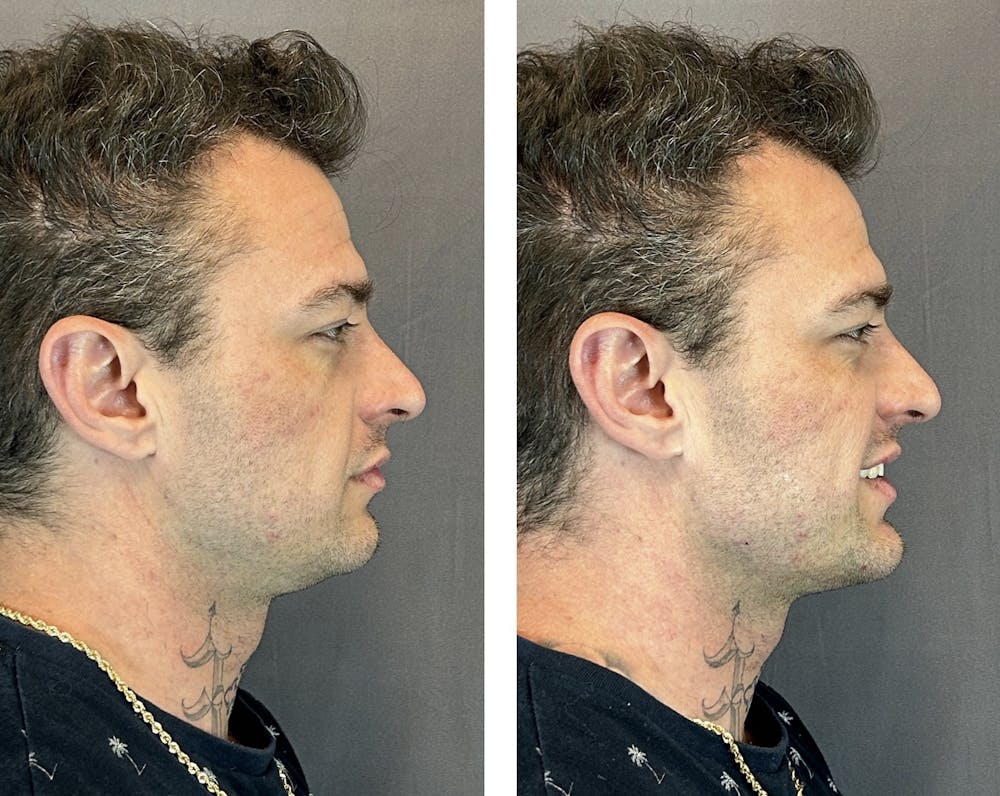 Dermal Fillers Before & After Gallery - Patient 143591521 - Image 5