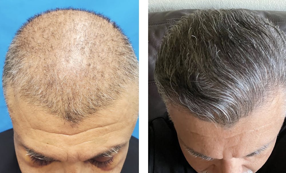 Hair Restoration  Before & After Gallery - Patient 143591522 - Image 1