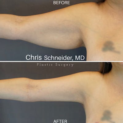 Arm Lift Before & After Gallery - Patient 144151425 - Image 1