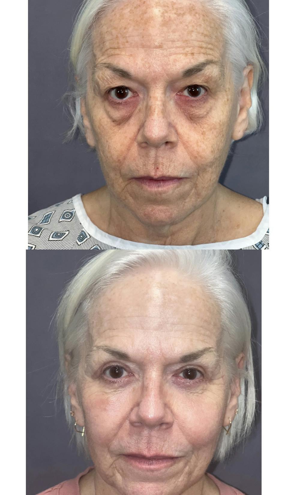 Upper Blepharoplasty Before & After Gallery - Patient 144174548 - Image 3