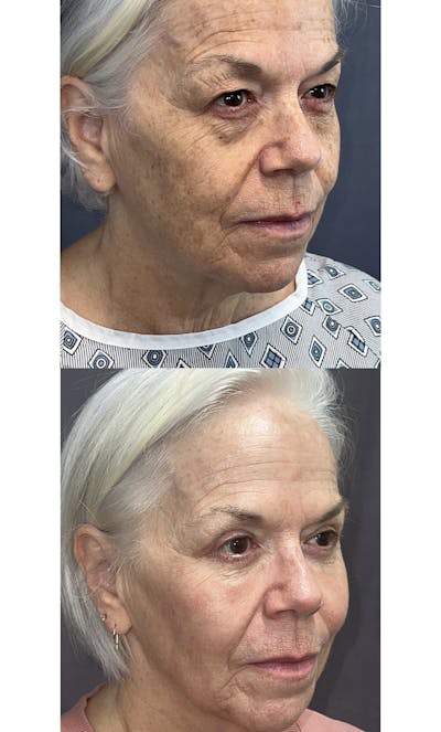 Upper Blepharoplasty Before & After Gallery - Patient 144174548 - Image 2