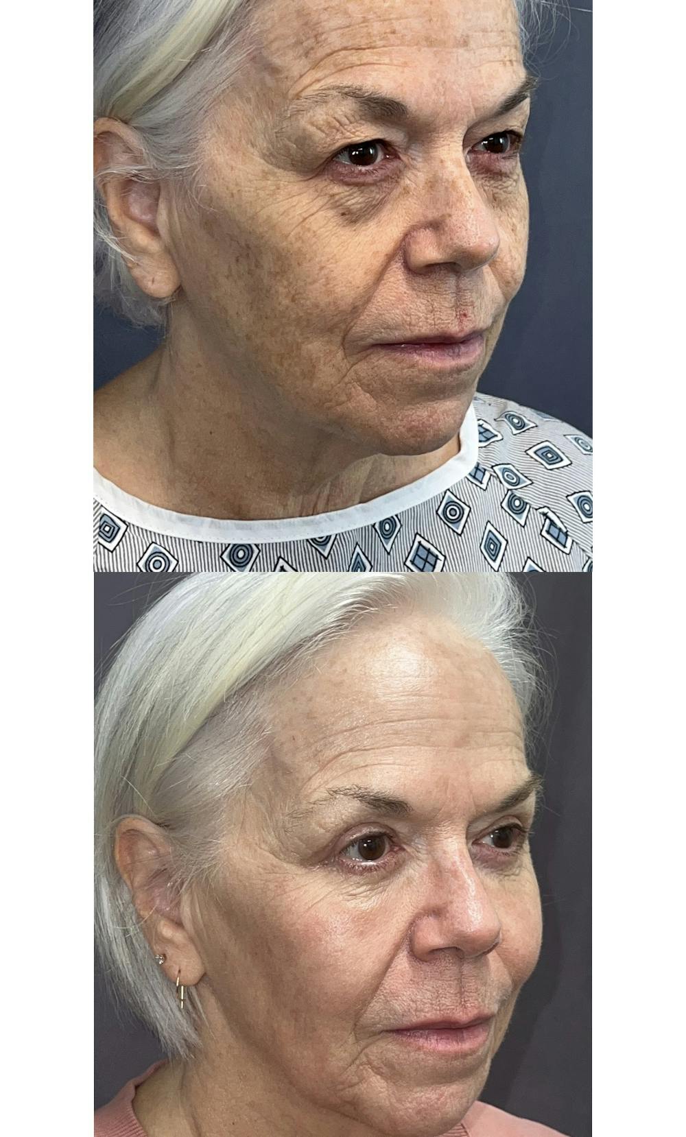 Upper Blepharoplasty Before & After Gallery - Patient 144174548 - Image 2