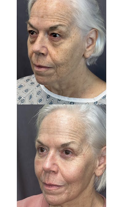 Upper Blepharoplasty Before & After Gallery - Patient 144174548 - Image 1