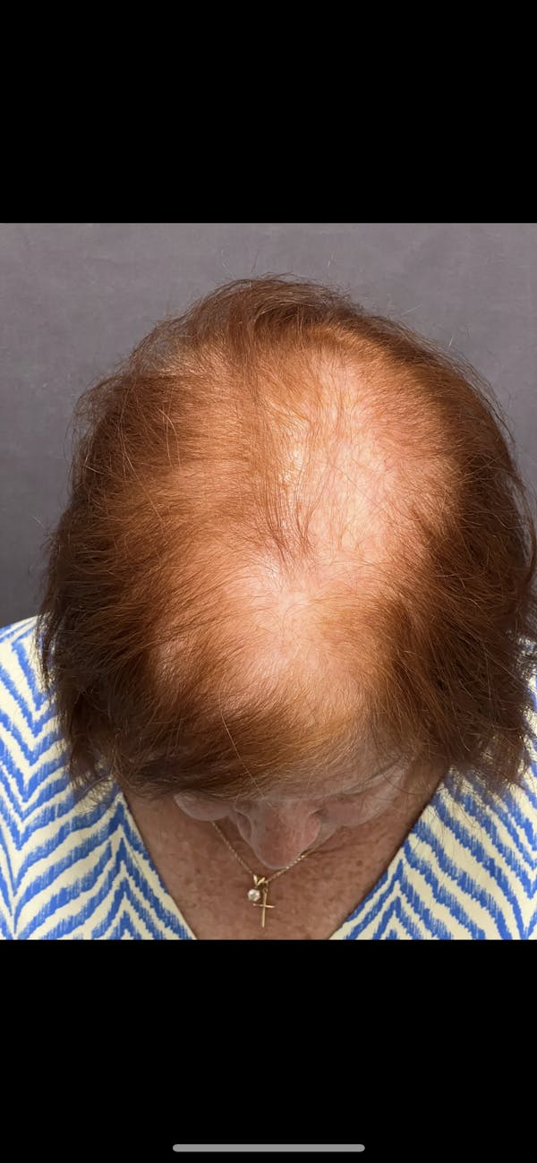 Hair Restoration  Before & After Gallery - Patient 144658915 - Image 1