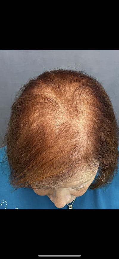 Hair Restoration  Before & After Gallery - Patient 144658915 - Image 2