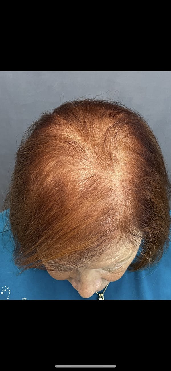 Hair Restoration  Before & After Gallery - Patient 144658915 - Image 2