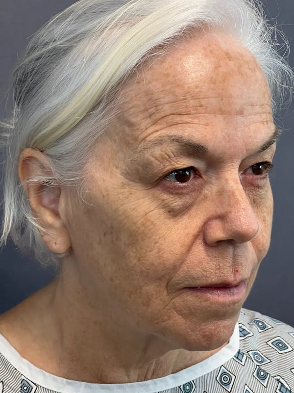 Upper Blepharoplasty Before & After Gallery - Patient 144296786 - Image 3