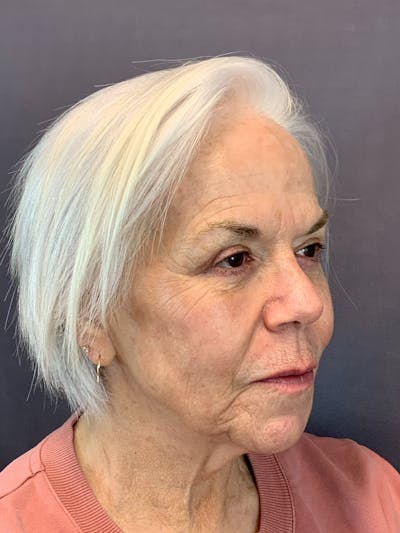 Upper Blepharoplasty Before & After Gallery - Patient 144296786 - Image 4