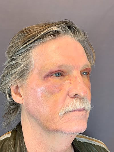Lower Blepharoplasty Before & After Gallery - Patient 144296793 - Image 2