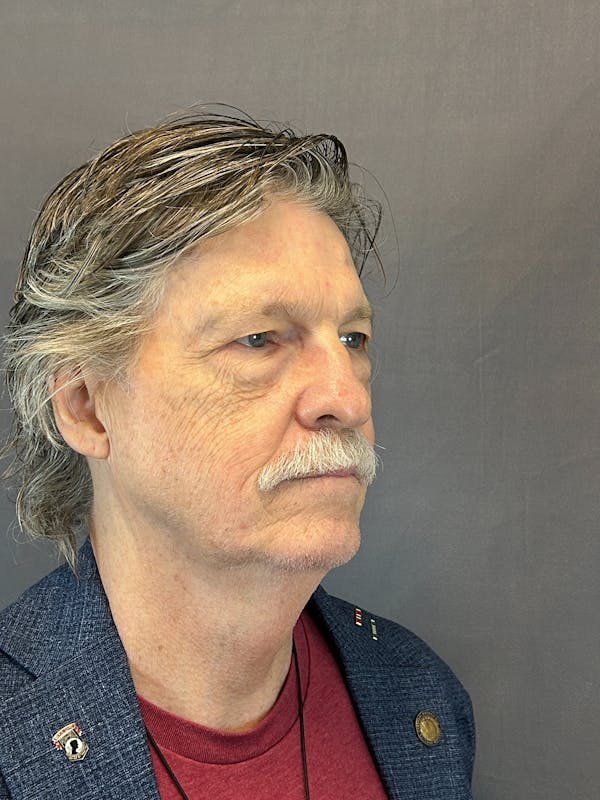 Laser Resurfacing Before & After Gallery - Patient 323933 - Image 1