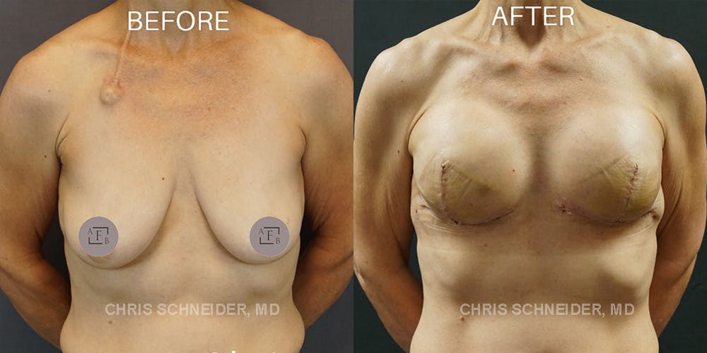 Breast Reconstruction  Before & After Gallery - Patient 144977815 - Image 1