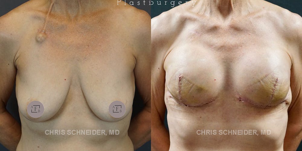 Breast Reconstruction  Before & After Gallery - Patient 144977815 - Image 2