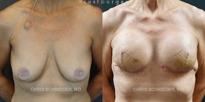Breast Reconstruction  Before & After Gallery - Patient 144977815 - Image 2