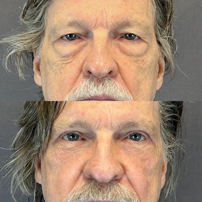 Upper Blepharoplasty Before & After Gallery - Patient 144296792 - Image 1