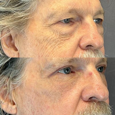 Upper Blepharoplasty Before & After Gallery - Patient 144296792 - Image 2