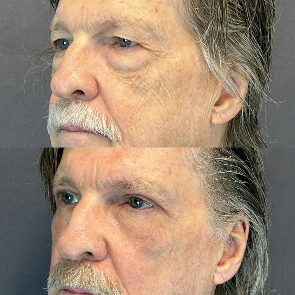 Upper Blepharoplasty Before & After Gallery - Patient 144296792 - Image 3