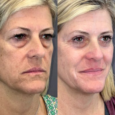 Laser Resurfacing Before & After Gallery - Patient 145833618 - Image 2